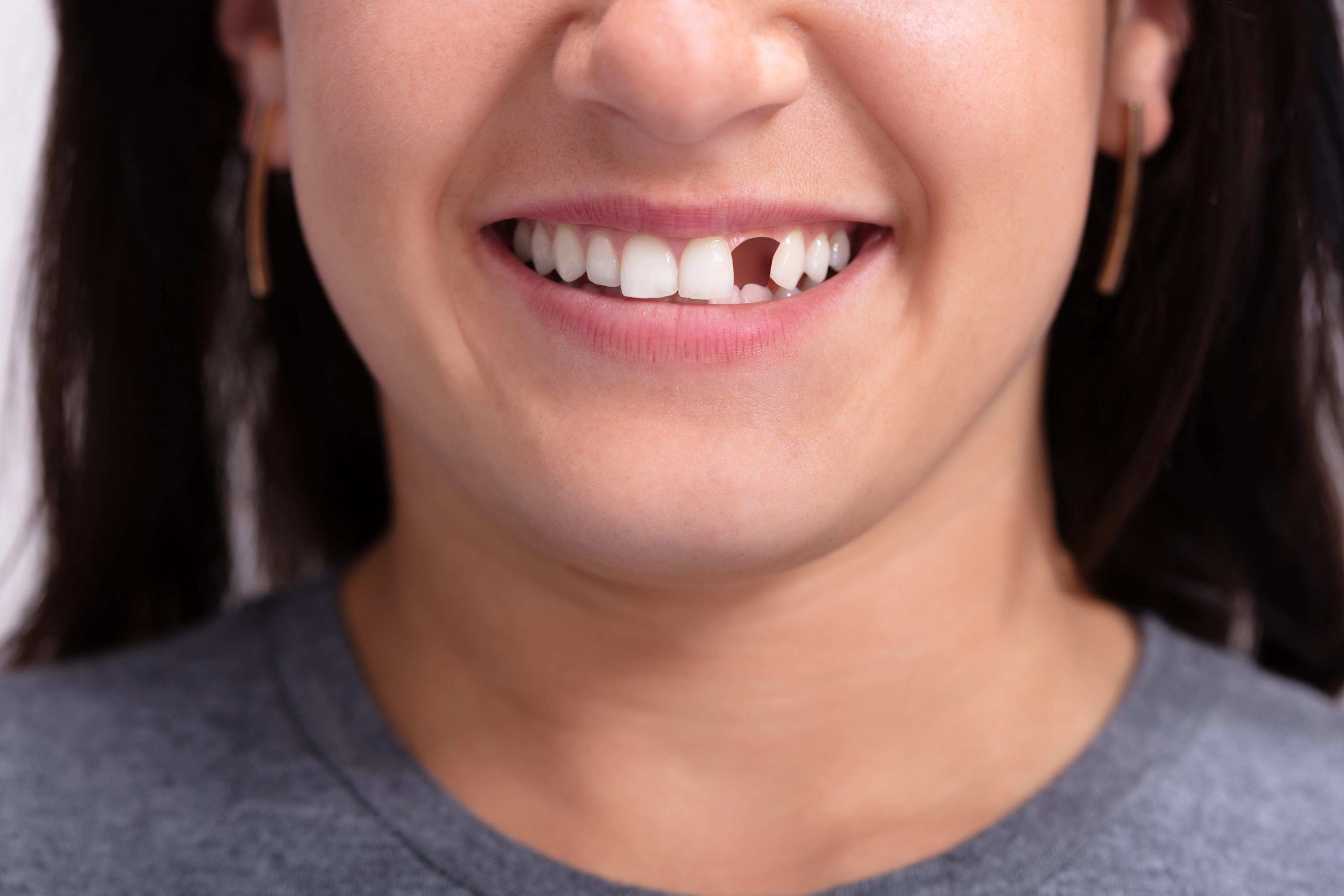 Emergency Broken Tooth Repair: Your Guide to Fast Relief and Recovery